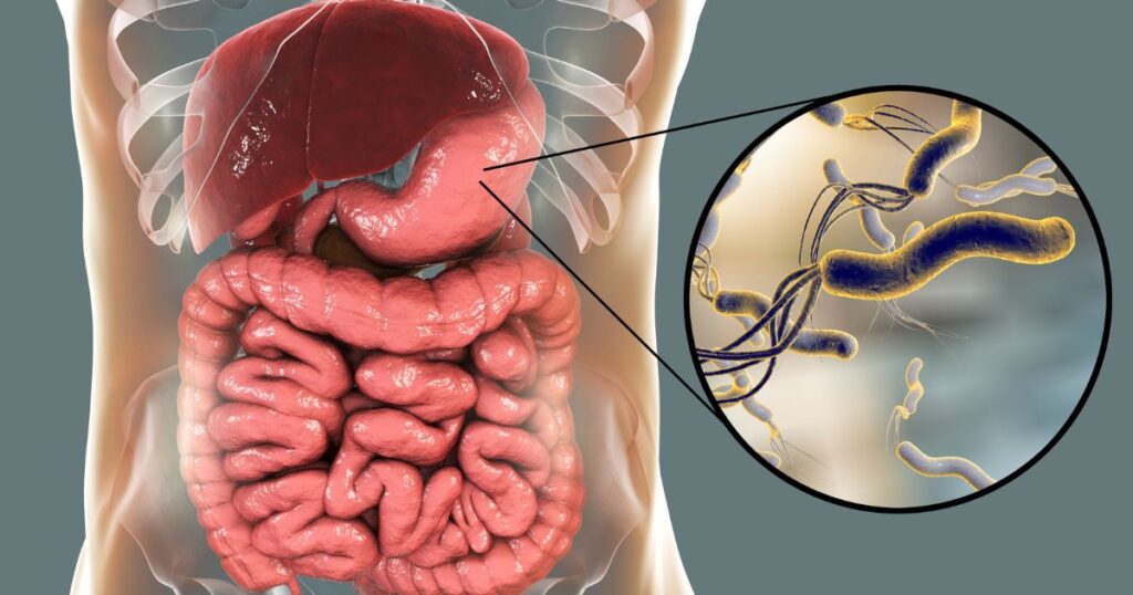 sintomas da H. Pylori no estômago